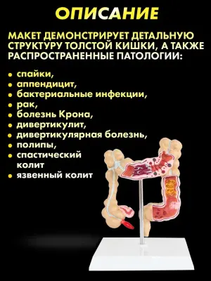 Анатомическая модель с заболеваниями толстой кишки человека