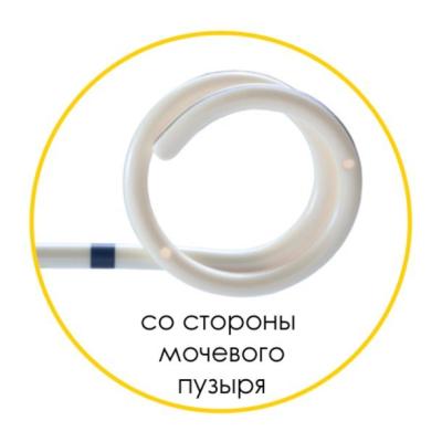 Мочеточниковый стент Urotech White Star набор, двойной завиток, открытый тип, проводник