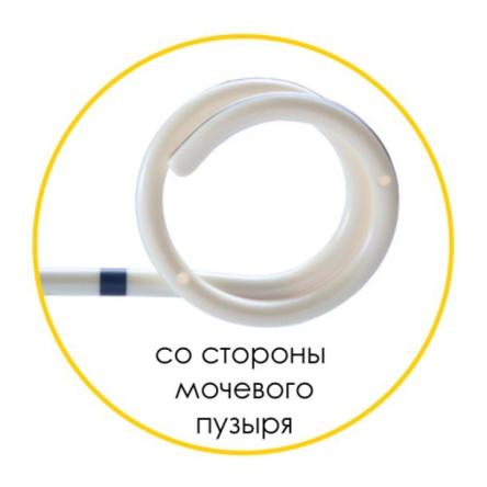 Купить Мочеточниковый стент Urotech White Star набор, двойной завиток, открытый тип, проводник