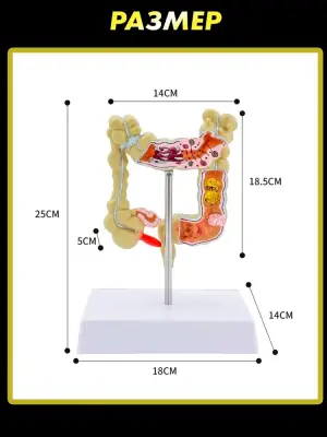 Анатомическая модель с заболеваниями толстой кишки человека