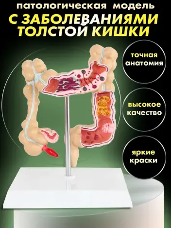 Анатомическая модель с заболеваниями толстой кишки человека