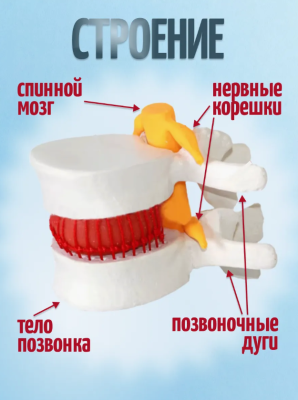 Анатомическая модель грыжи поясничного отдела