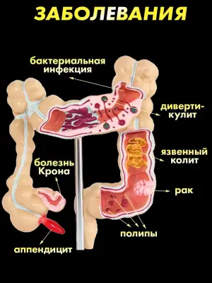 Анатомическая модель с заболеваниями толстой кишки человека