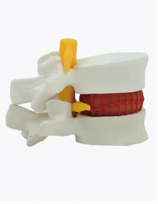 Анатомическая модель грыжи поясничного отдела