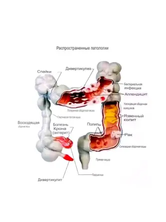 Купить Анатомическая модель с заболеваниями толстой кишки человека 7